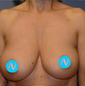 Breast Lift Before & After Image