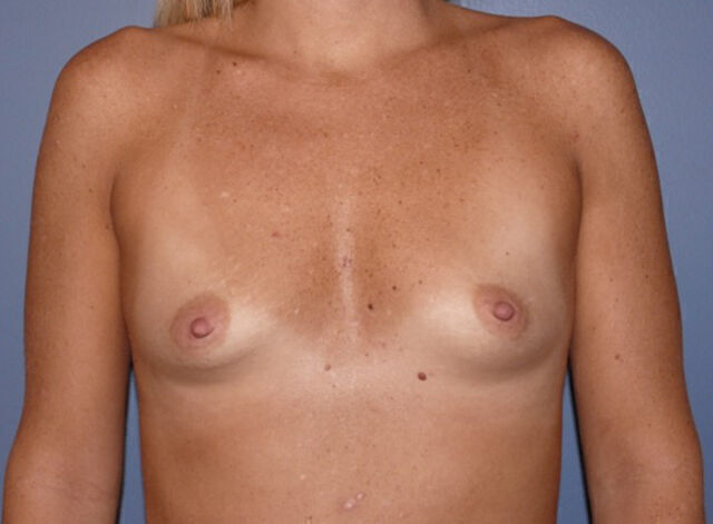 Breast Reconstruction Before & After Image