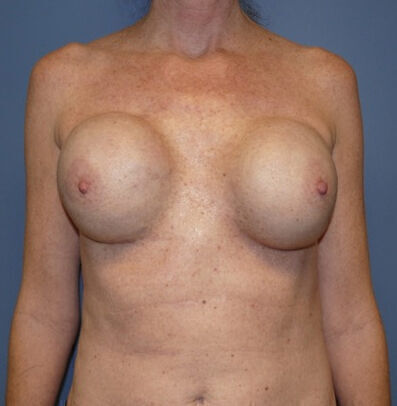 Breast Reconstruction Before & After Image