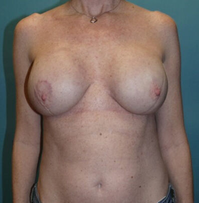 Breast Reconstruction Before & After Image