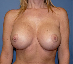 Breast Reconstruction Before & After Image