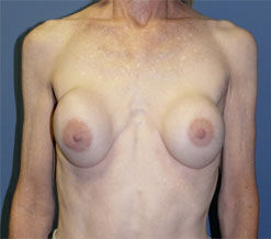 Breast Reconstruction Before & After Image