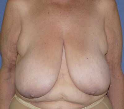 Breast Reduction Before & After Image