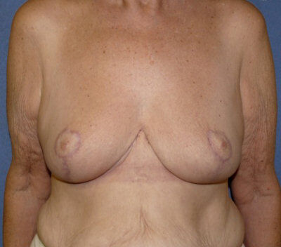 Breast Reduction Before & After Image