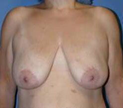 Breast Reduction Before & After Image