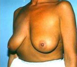 Breast Before & After Image