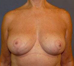 Breast Reduction Before & After Image