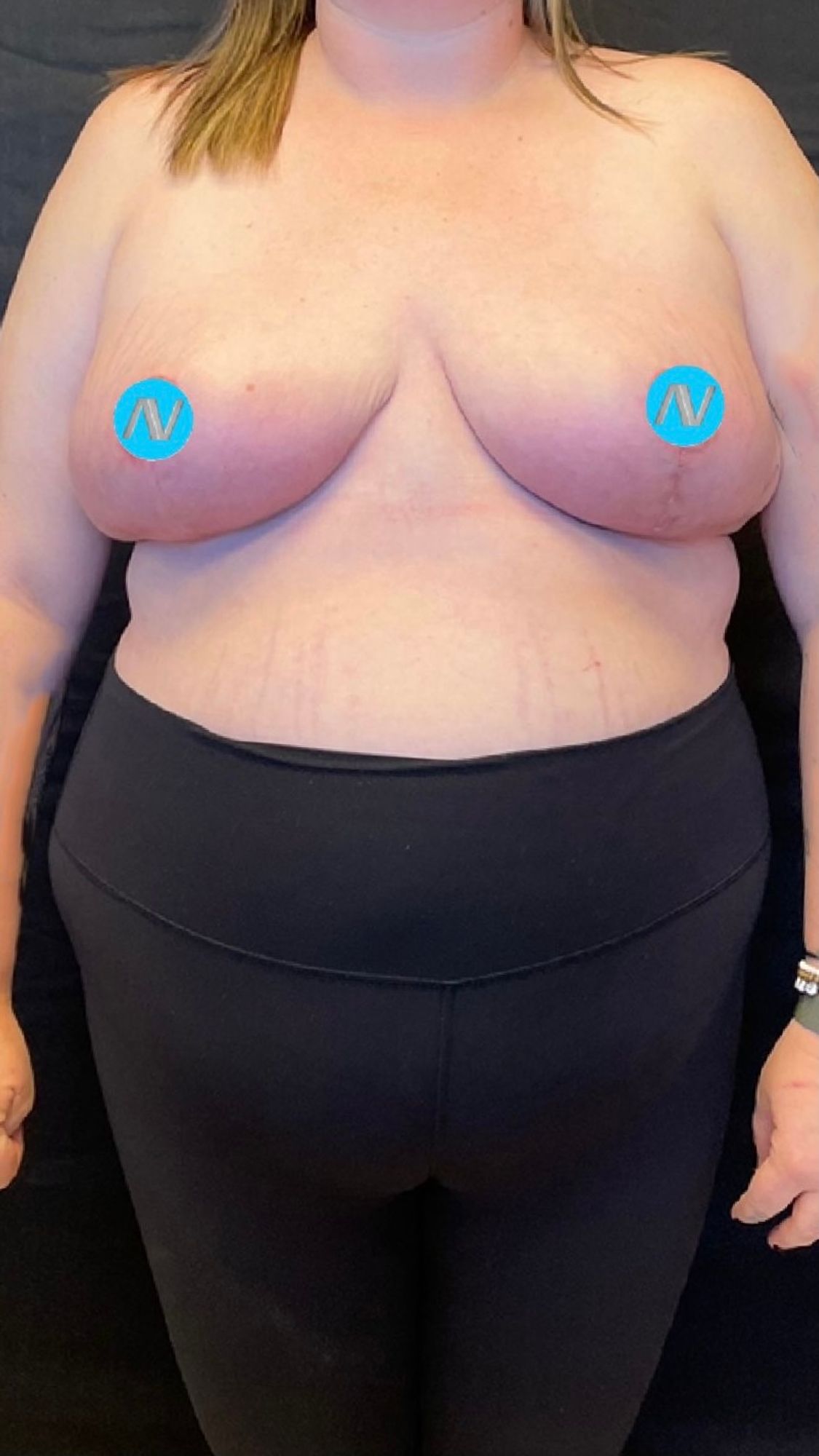 Breast Reduction Before & After Image