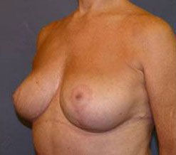 Breast Before & After Image