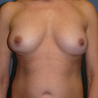 En Bloc Capsulectomy Before & After Image