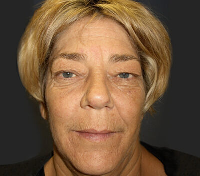 Blepharoplasty Before & After Image