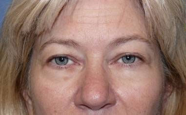 Blepharoplasty Before & After Image