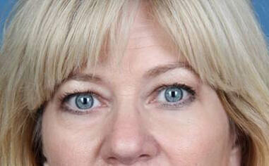 Blepharoplasty Before & After Image