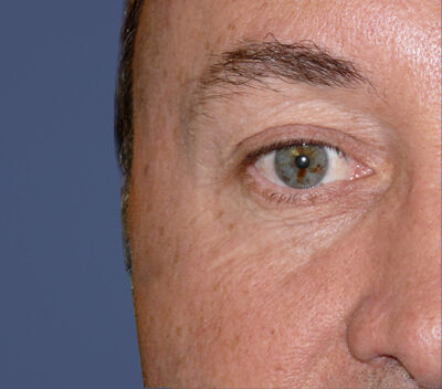 Blepharoplasty Before & After Image