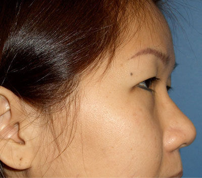 Blepharoplasty Before & After Image