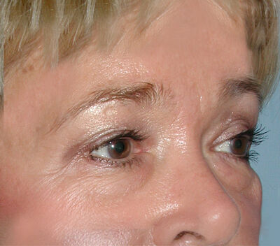 Blepharoplasty Before & After Image