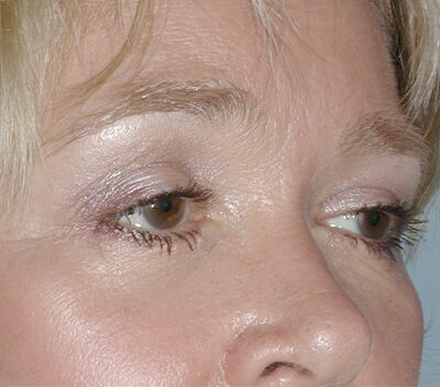 Blepharoplasty Before & After Image