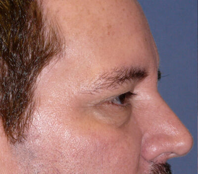 Blepharoplasty Before & After Image