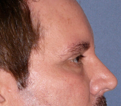 Blepharoplasty Before & After Image