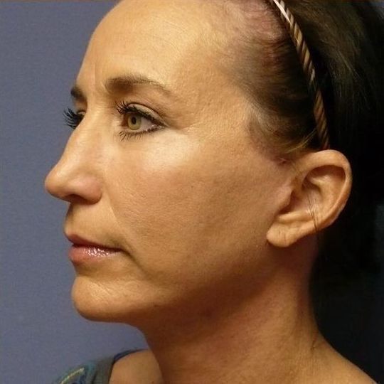 Blepharoplasty Before & After Image