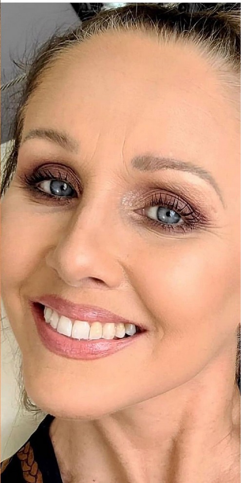 Brow Lift Before & After Image