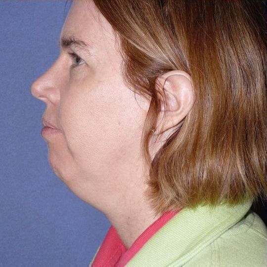 Chin Augmentation Before & After Image