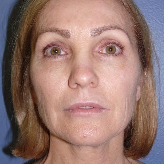 Deep Plane Facelift Before & After Image