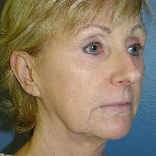 Deep Plane Facelift Before & After Image