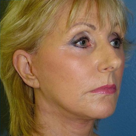 Deep Plane Facelift Before & After Image