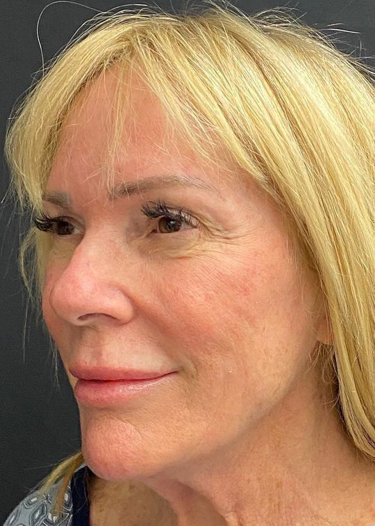 Deep Plane Facelift Before & After Image