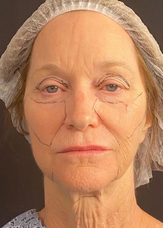 Deep Plane Facelift Before & After Image