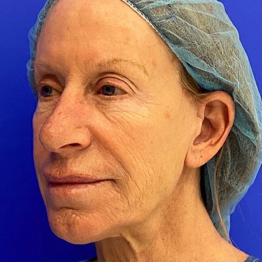 Deep Plane Facelift Before & After Image