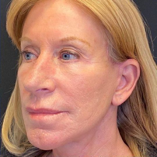 Deep Plane Facelift Before & After Image