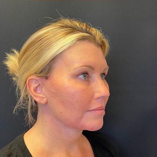 Deep Plane Facelift Before & After Image