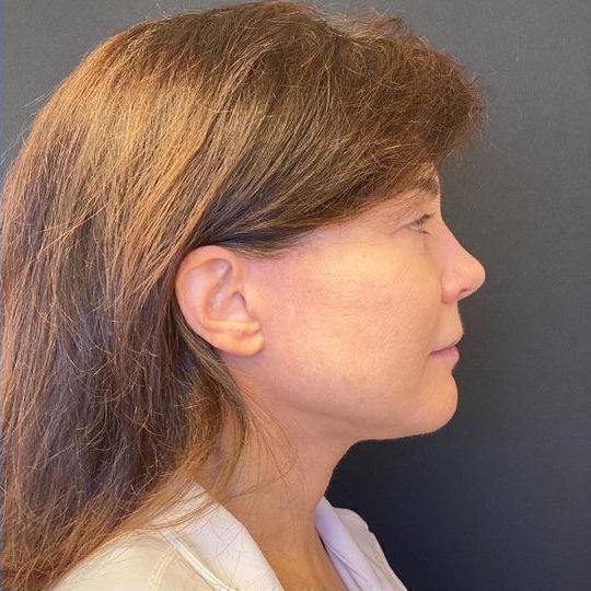 Deep Plane Facelift Before & After Image