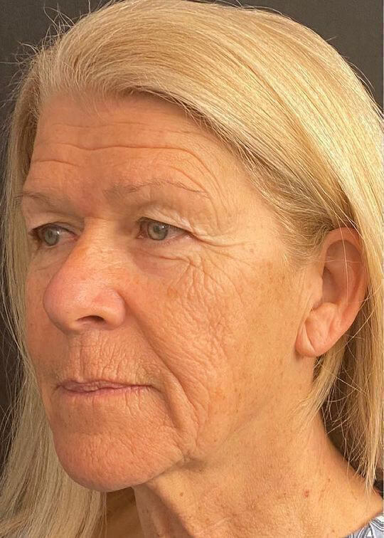 Deep Plane Facelift Before & After Image