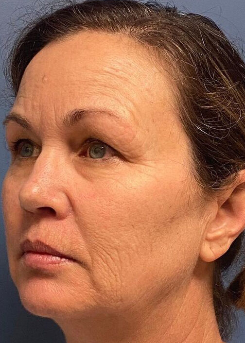 Deep Plane Facelift Before & After Image