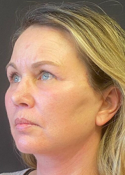 Deep Plane Facelift Before & After Image