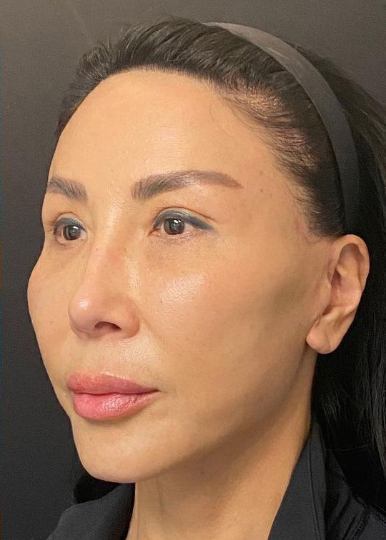 Deep Plane Facelift Before & After Image