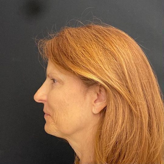 Deep Plane Facelift Before & After Image