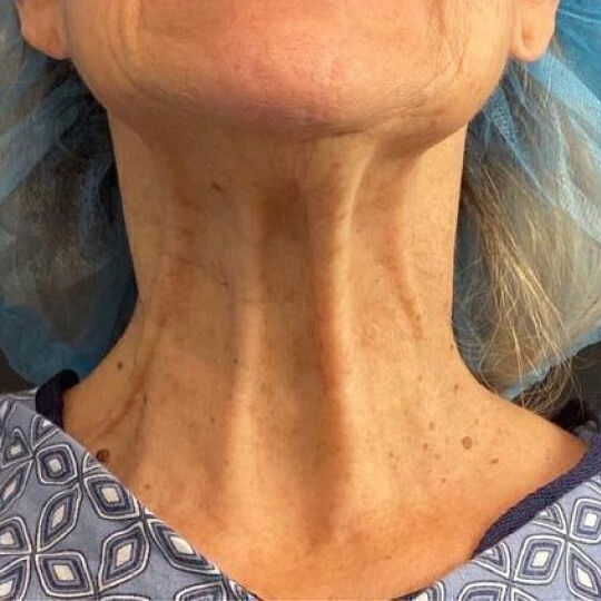 Deep Plane Facelift Before & After Image