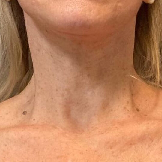 Deep Plane Facelift Before & After Image