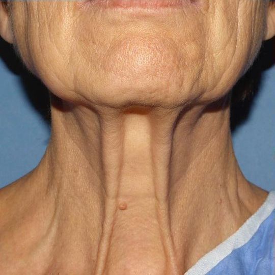 Deep Plane Facelift Before & After Image