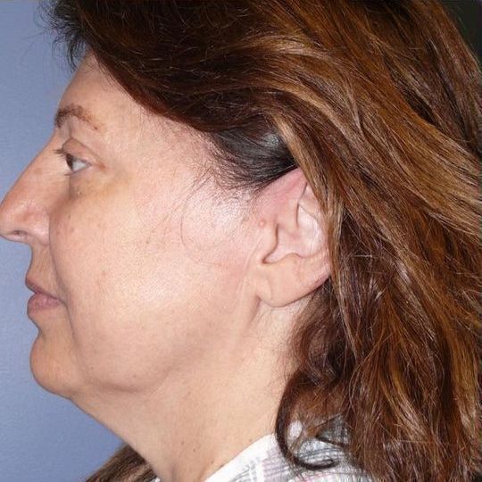 Deep Plane Facelift Before & After Image