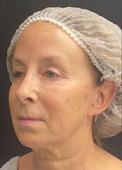 Deep Plane Facelift Before & After Image