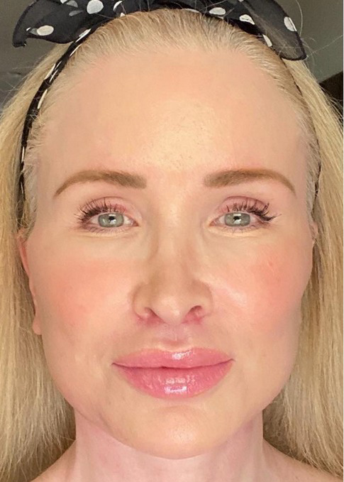 Deep Plane Facelift Before & After Image