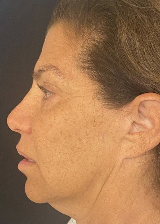 Deep Plane Facelift Before & After Image