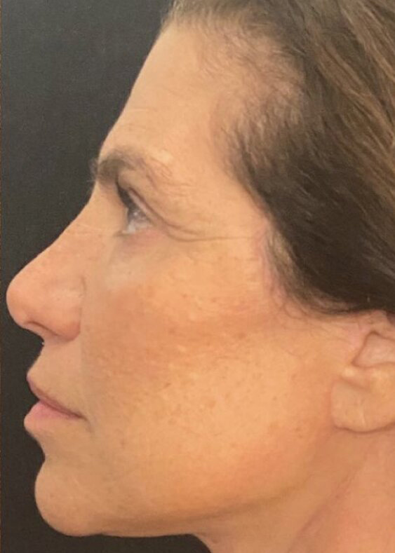 Deep Plane Facelift Before & After Image