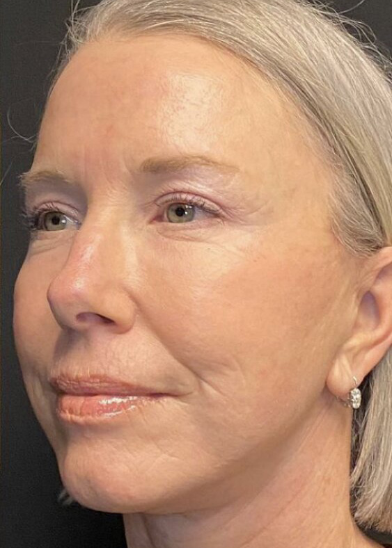 Deep Plane Facelift Before & After Image