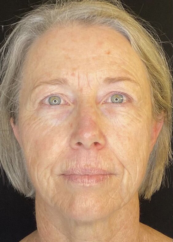 Deep Plane Facelift Before & After Image